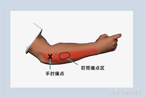 大拇指前端痛|『手部疼痛地图』教你对图自查！